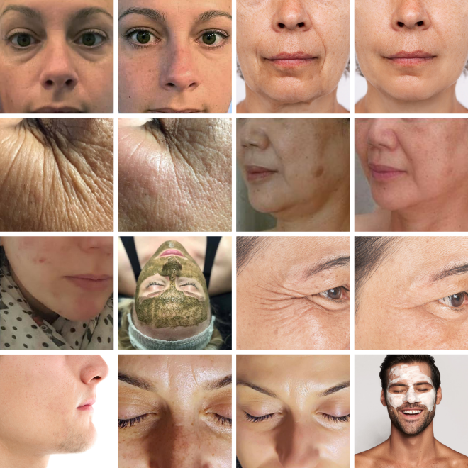 2B Bio Peeling antes y después de 660×660 02